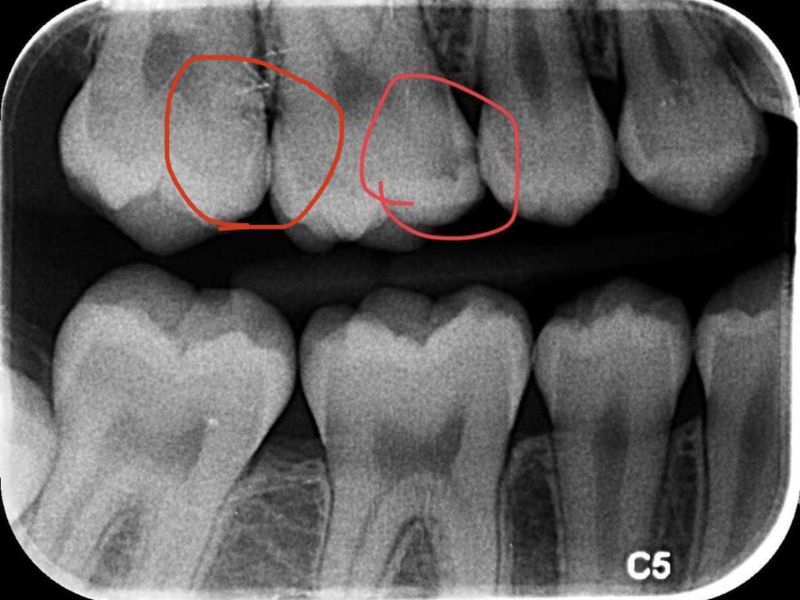 Kỹ thuật chụp X-quang sử dụng tia bức xạ, nhưng lượng tia này trong nha khoa rất nhỏ và được kiểm soát chặt chẽ để đảm bảo an toàn